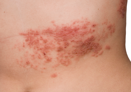 Vacina contra herpes-zóster Shingrix