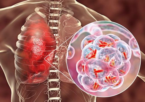 Vacina da Pneumonia: qual escolher para garantir mais proteção?